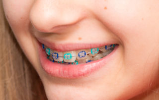 kids-orthodontist-garden-grove-best-orthodontist-orange-county