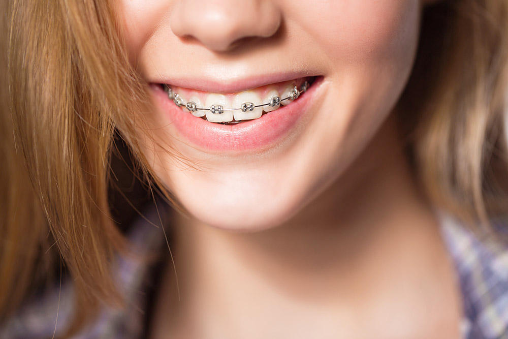 best-kids-orthodontist-garden-grove-orange-county-ca-2