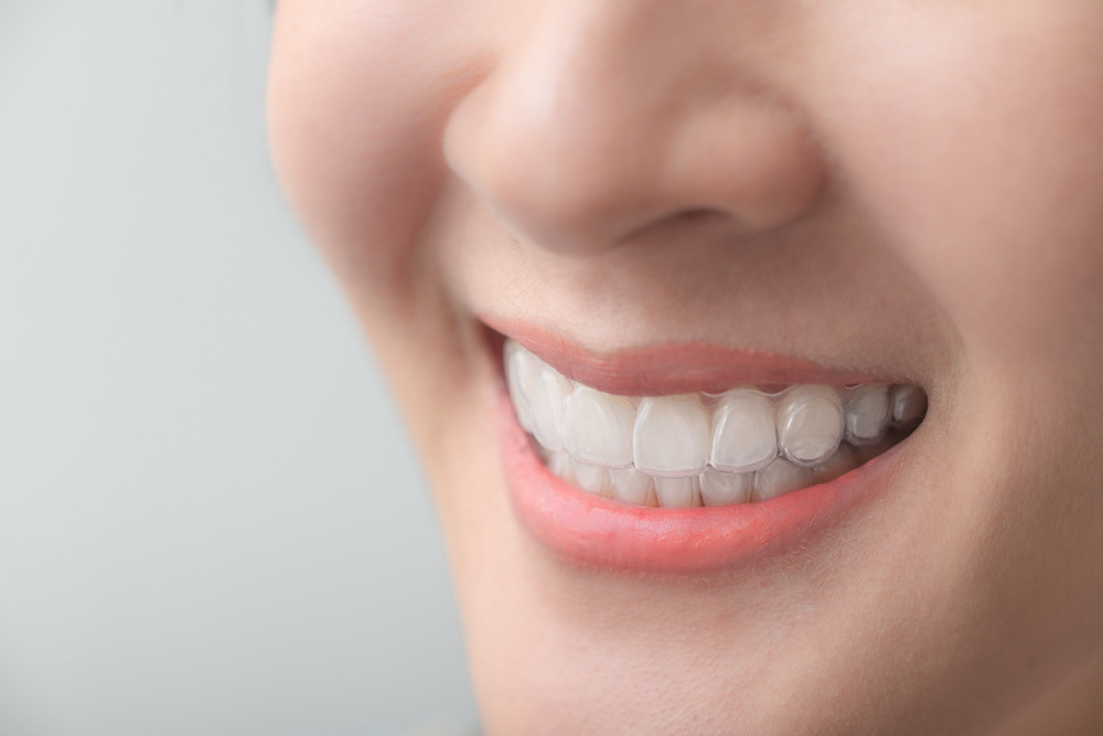 clear aligners for teens garden grove orange county