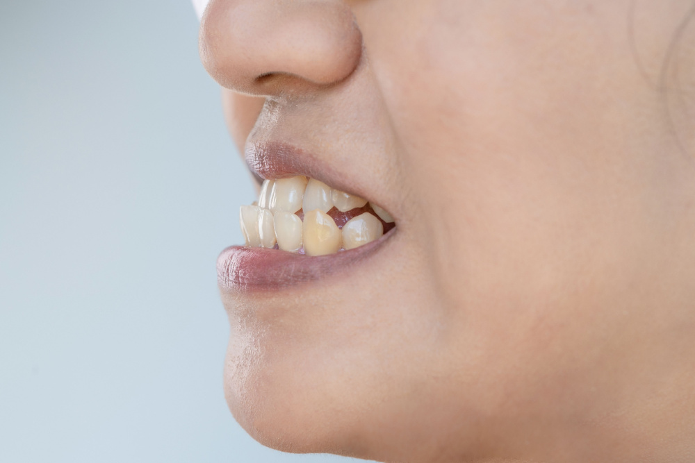Orthodontic Treatment for Overbite and Underbite Garden Grove Orthodontist