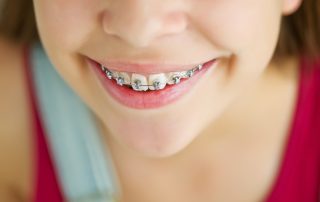Why Early Orthodontic Treatment is Important