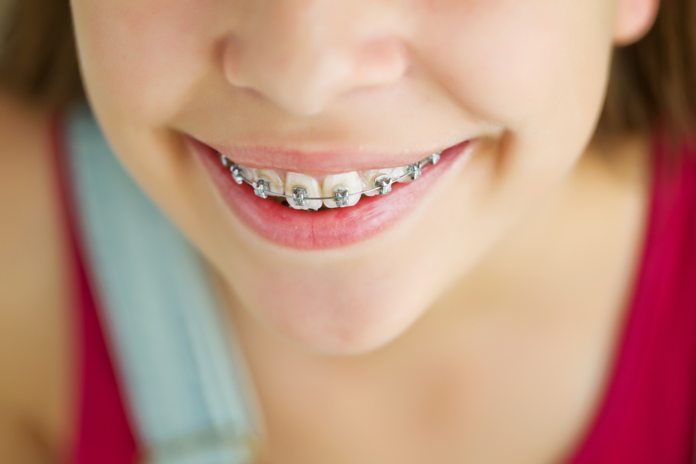 Why Early Orthodontic Treatment is Important