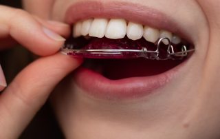 The Importance of Orthodontic Retention
