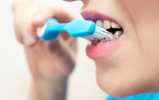 How to Prepare for Orthodontic Treatment