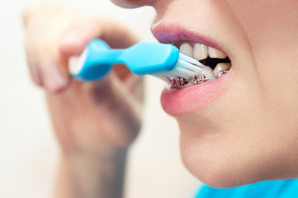 How to Prepare for Orthodontic Treatment